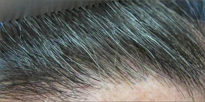 THC w mieszkach wlosowych