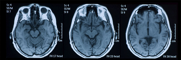 CBD opóźnia rozwój chorób mózgu