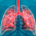 Wspomaga leczenie nowotworów, epilepsji, artretyzmu, cukrzycy i depresji. Okazuje się też, że kannabidiol CBD – czyli związek organiczny zawarty w roślinach konopi może ograniczyć nadmierny proces zapalny w płucach, który prowadzi do śmierci osób, które zachorowały na COVID-19. Poinformowali o tym naukowcy na łamach pisma „Cannabis and Cannabinoid Research”.